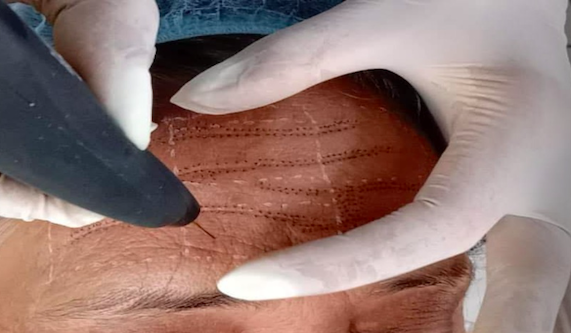 Fibroblast, Plasma Pen, Mole Removal Certification